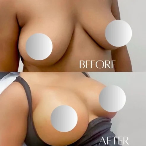 Fat Transfer To Breast Before and After